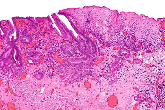 Microcarcicoma de esófago. / Wikipedia