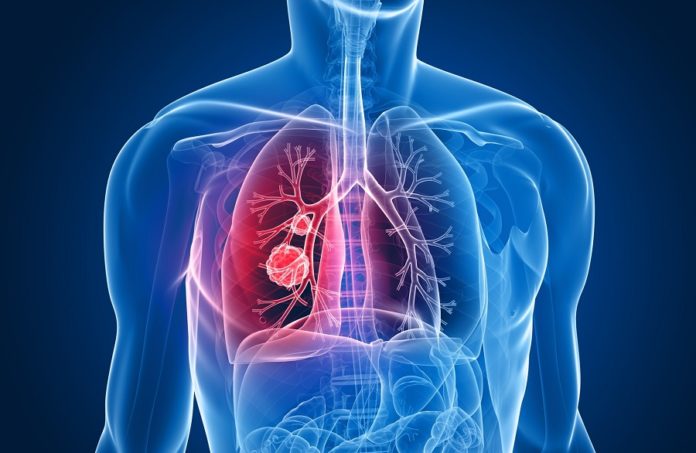 Os biomarcadores serven para a diagnose temperá do cancro de pulmón.