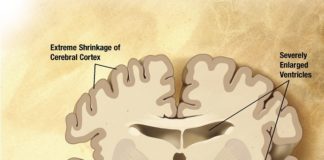 Representación dun corte cerebrral afectado por alzhéimer.