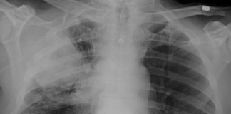 Radiografía que amosa a existencia dun posible tumor no pulmón. O mencionado estudo tamén sinala, con todo, que os cancros deste órgano están provocados na súa maior parte por factores ambientais.