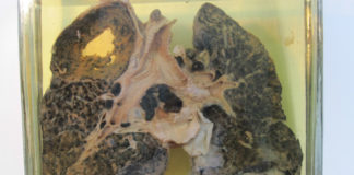 Pulmón dun mineiro afectado por silicose e tuberculose. Imaxe: Museo Vasco de Historia da Medicina e as Ciencias.