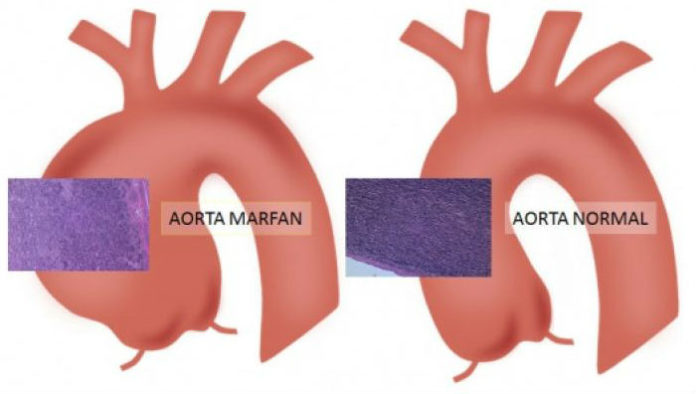 A síndrome de Marfan adoita producir ensanchamentos na aorta. Fonte: Universitat de Barcelona.