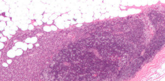 Micrografía que amosa un ganglio linfático invadido por un carcinoma de mama. / Wikipedia.