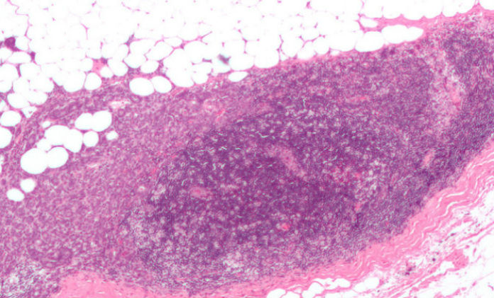 Micrografía que amosa un ganglio linfático invadido por un carcinoma de mama. / Wikipedia.