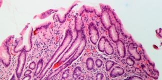 A H. pylori pode provocar úlceras e inflamacións no aparello gástrico e, nalgúns casos, induce a aparición de cancro.