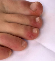 Frieiras detectadas nas dedas de pacientes de Covid-19. Foto: AEDV.