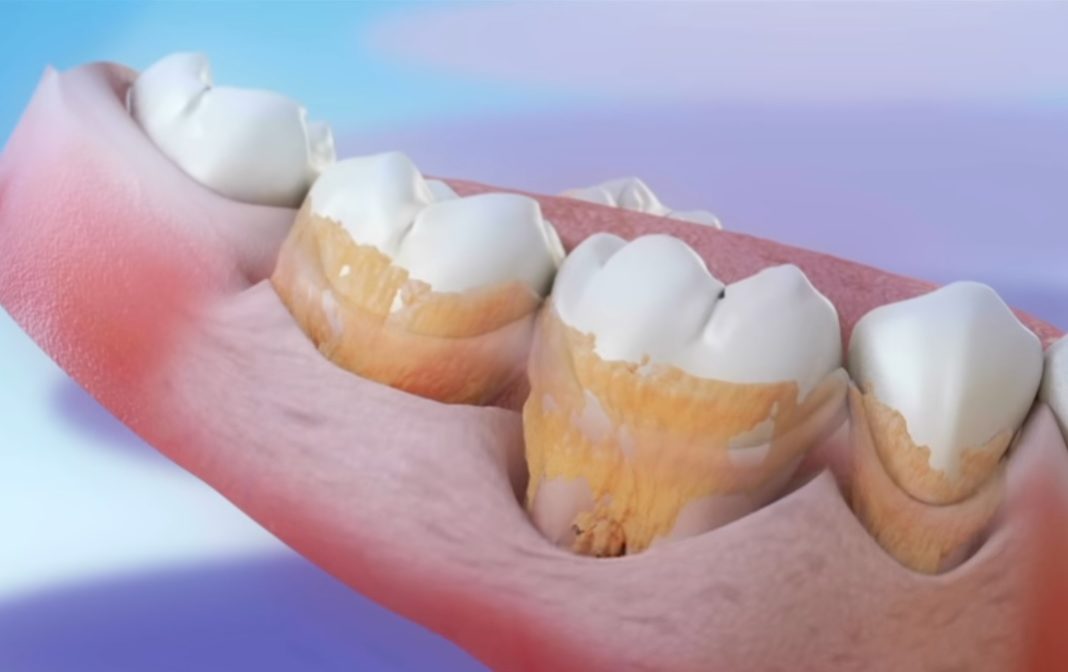 A periodontite ou piorrea é un dos problemas dentais máis frecuentes. Fonte: Clínica Pardiñas.