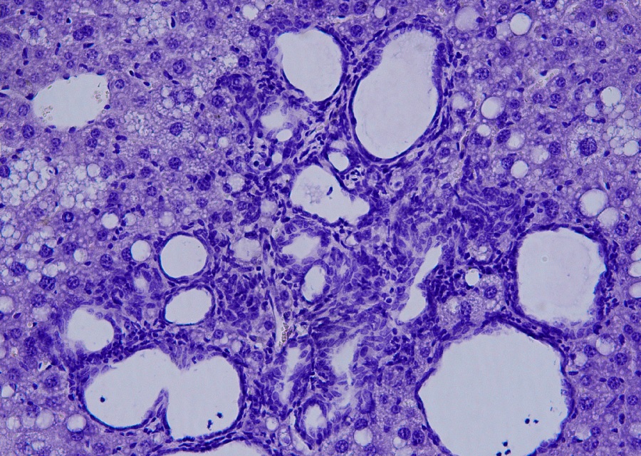 Imaxe ao microscopio dun colanxiocarcinoma. Foto: CNIC.