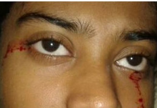 Nena de 15 anos con hemolacria, nun caso estudado en 2016 en Nova Delhi (India). Foto: BMJ Case Reports.