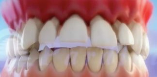 O desgaste causado pola periodontite pode acabar provocando a caída dos dentes. Fonte: Clínica Pardiñas.