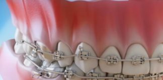 A ortodoncia é un recurso ás veces estético, pero que tamén pode previr algunhas patoloxías. Imaxe: Clínica Pardiñas.