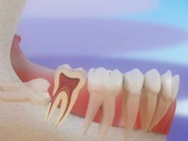 As moas do siso poden causar complicacións na dentadura ao emerxer de forma incorrecta. Fonte: Clínica Pardiñas.