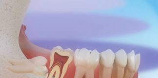 As moas do siso poden causar complicacións na dentadura ao emerxer de forma incorrecta. Fonte: Clínica Pardiñas.