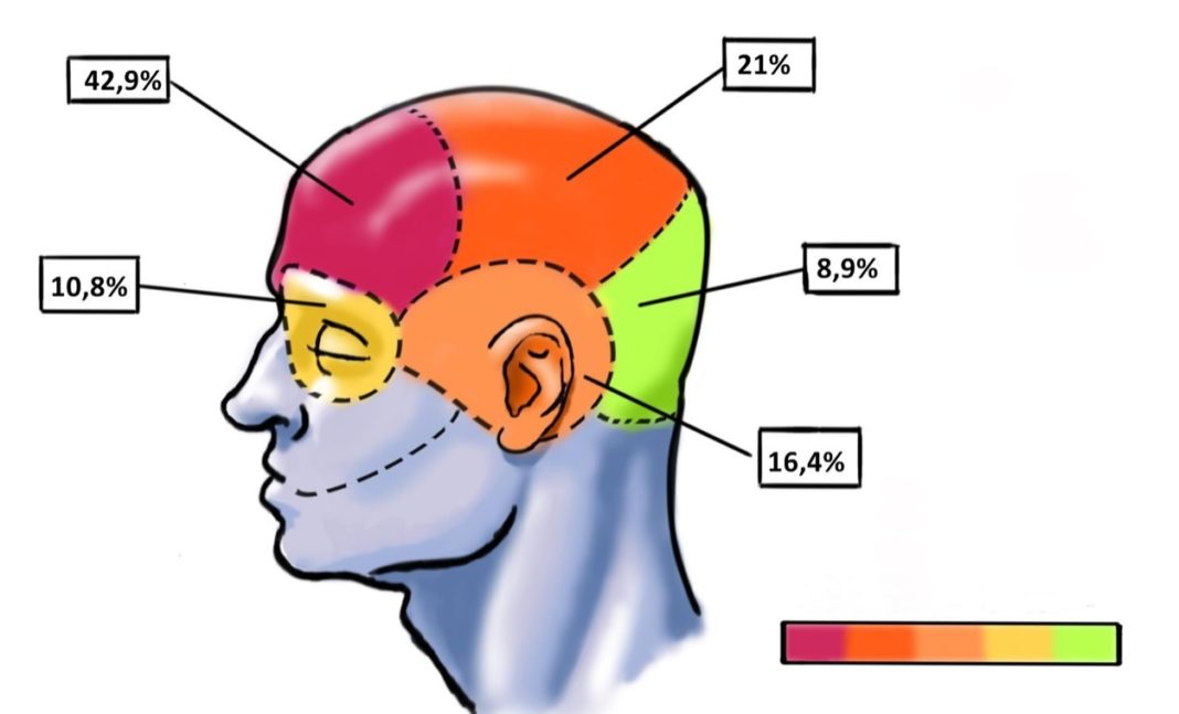 A maioría dos participantes no estudo manifestou unha dor xeral na cabeza, máis intensa na zona frontal. Fonte: Dicyt.