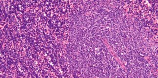 Micrografía dun nodo linfático afectado por leucemia linfocítica crónica. Crédito: Nephron-Wikipedia