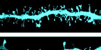 Imaxe microscópica das espiñas dendríticas, a zona da neurona onde se produce a sinapse. Obsérvanse diferenzas na morfoloxía das fibras dopaminérxicas entre un grupo de control (imaxe superior) e un grupo experimental (imaxe inferior). Crédito: CIMA / Universidad de Navarra