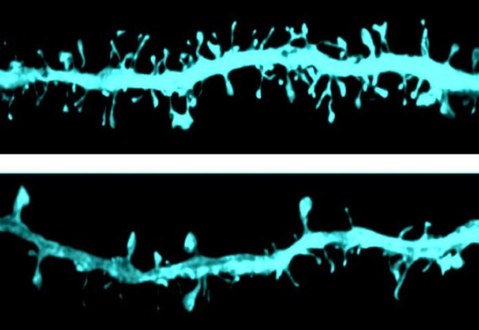 Imaxe microscópica das espiñas dendríticas, a zona da neurona onde se produce a sinapse. Obsérvanse diferenzas na morfoloxía das fibras dopaminérxicas entre un grupo de control (imaxe superior) e un grupo experimental (imaxe inferior). Crédito: CIMA / Universidad de Navarra