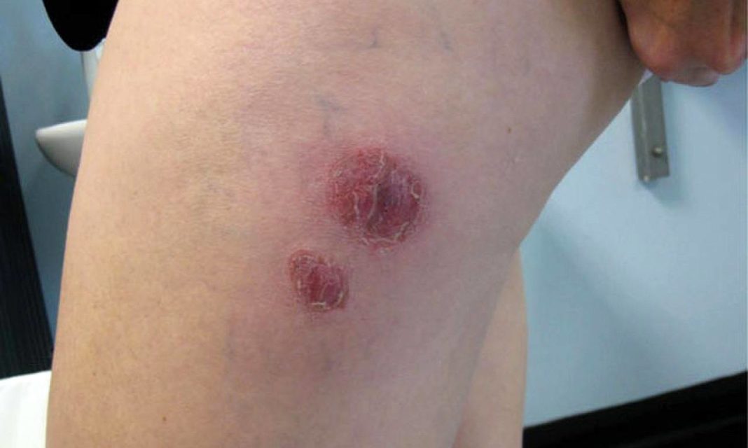 Abscesos producidos pola infección M. chelonae. / Erina Gray/ Wikipedia/SINC