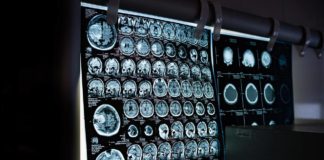 A resonancia magnética ponderada por difusión permite estudar a inflamación cerebral 'in vivo'. Foto: Pixabay