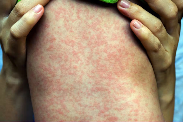 Bebé con sarampelo. Foto: Shutterstock / phichet chaiyabin