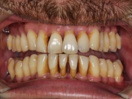 Exemplo dunha boca con periodontite