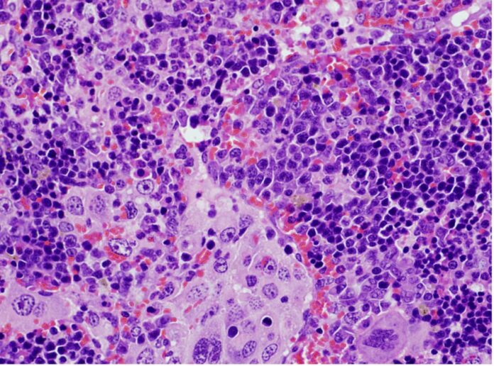 Imaxe de microscopía dun bazo que presenta un linfoma desenvolvido por ratos que expresan unha mutación oncoxénica do xene VAV1. Crédito: Xosé R. Bustelo