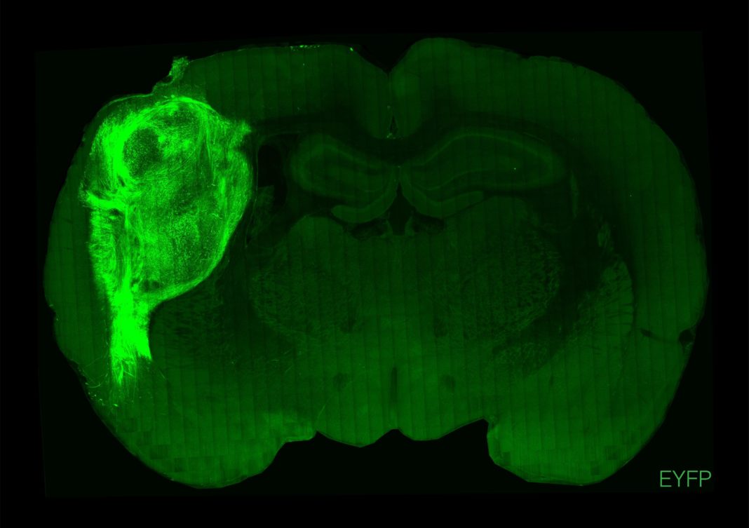 Un organoide humano transplantado e marcado cunha proteína fluorescente nunha sección do cerebro de rata. Crédito: Universidad de Stanford
