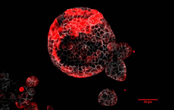 Organoide de cancro colorrectal con células residuais responsables da recaída marcadas en vermello. Crédito: IRB Barcelona