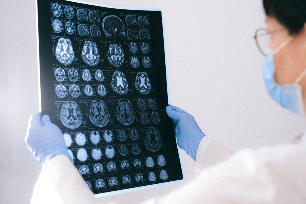 Un estudo elaborado por investigadores alemáns demostra que a adicción á cocaína provoca cambios químicos no cerebro asociados á idade avanzada. 