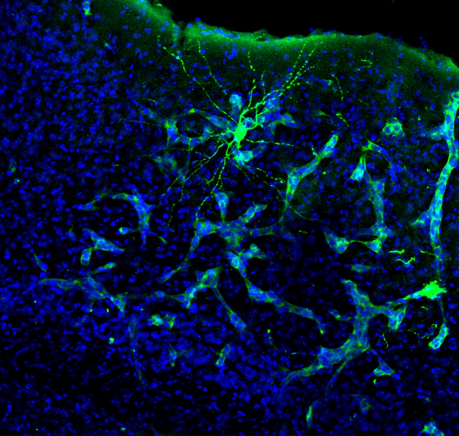Metástase en cerebro de rato. Apréciase como a metástase (verde máis claro) interacciona cunha neurona (verde máis intenso). Esta neurona está marcada especificamente para o seu estudo, pero a metástase está interaccionando con moitas máis. Foto: Manuel Valiente (CNIO)