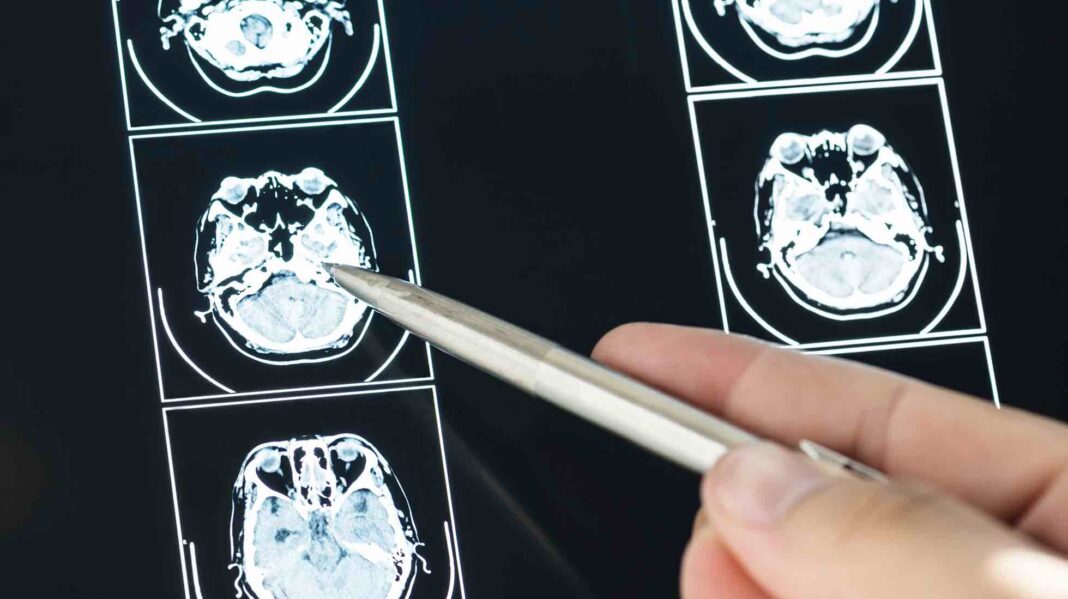 o glioblastoma é tumor cerebral máis común e agresivo en adultos. Foto: Freepik