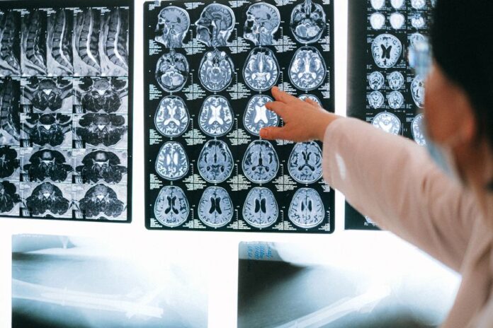 A prevención segue a ser a primeira ferramenta para loitar contra o ictus. Imaxe: Pexels